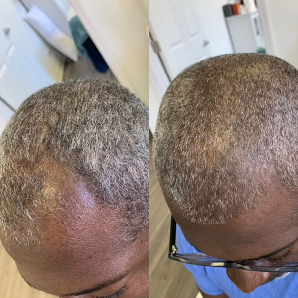 PRP Hair Restoration Before And After