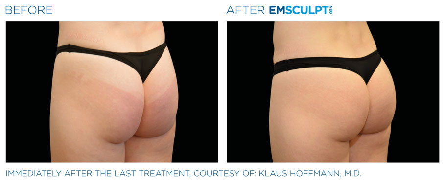 Emsculp Neo Female Buttock Before & After