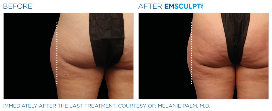Body Shaping Emsculpt Neo Before & After