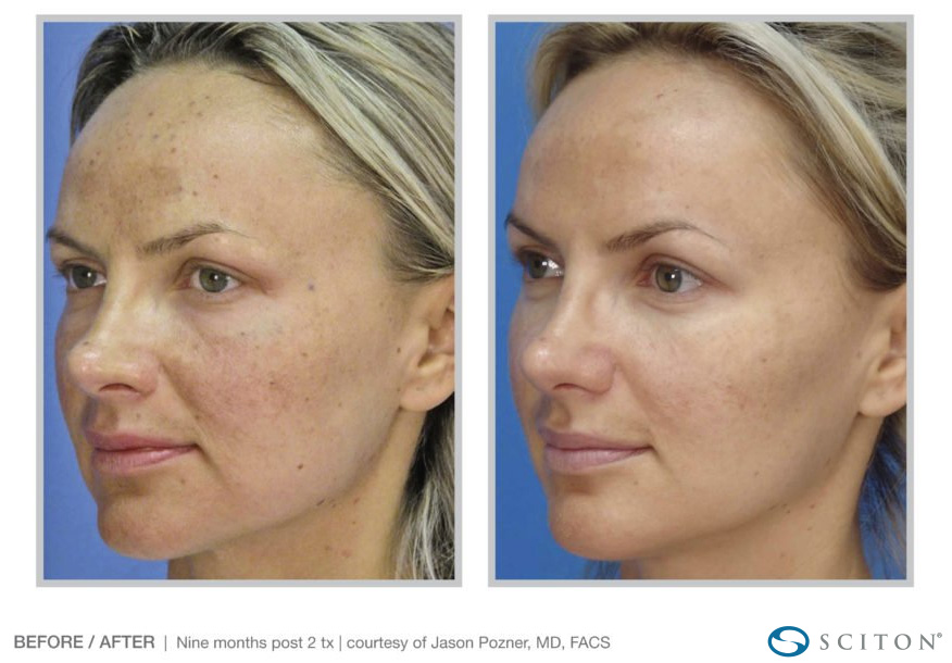 Pro Fractional Laser Resurfacing