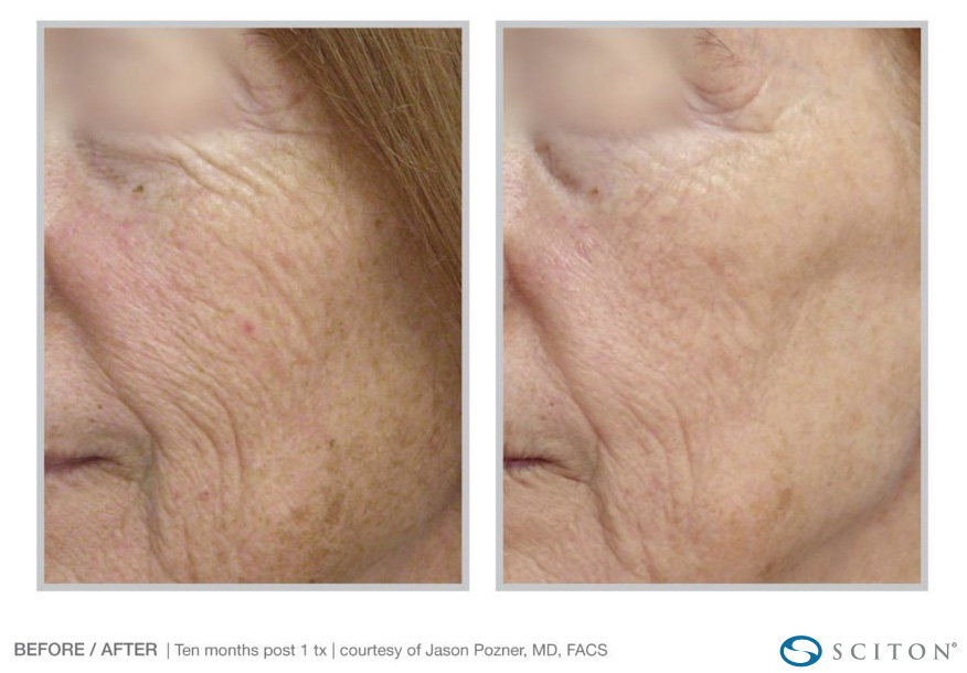 Nano Laser Peel