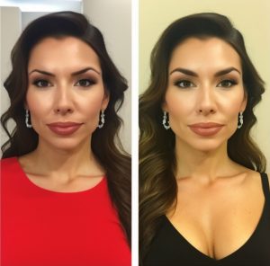 Eyebrow-Transplant