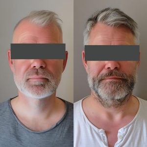 Hair Transplant Before and After Results