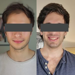 Hair Transplant Before and After Results