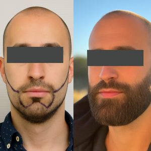Beard Transplant Before and After Results