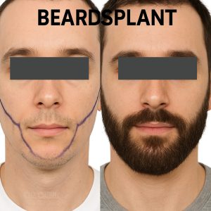 Beard Transplant Before and After Results