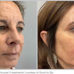 before-after-Photos-BBL-HERO_1
