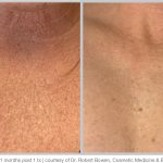 BBL Hero Before & After Results