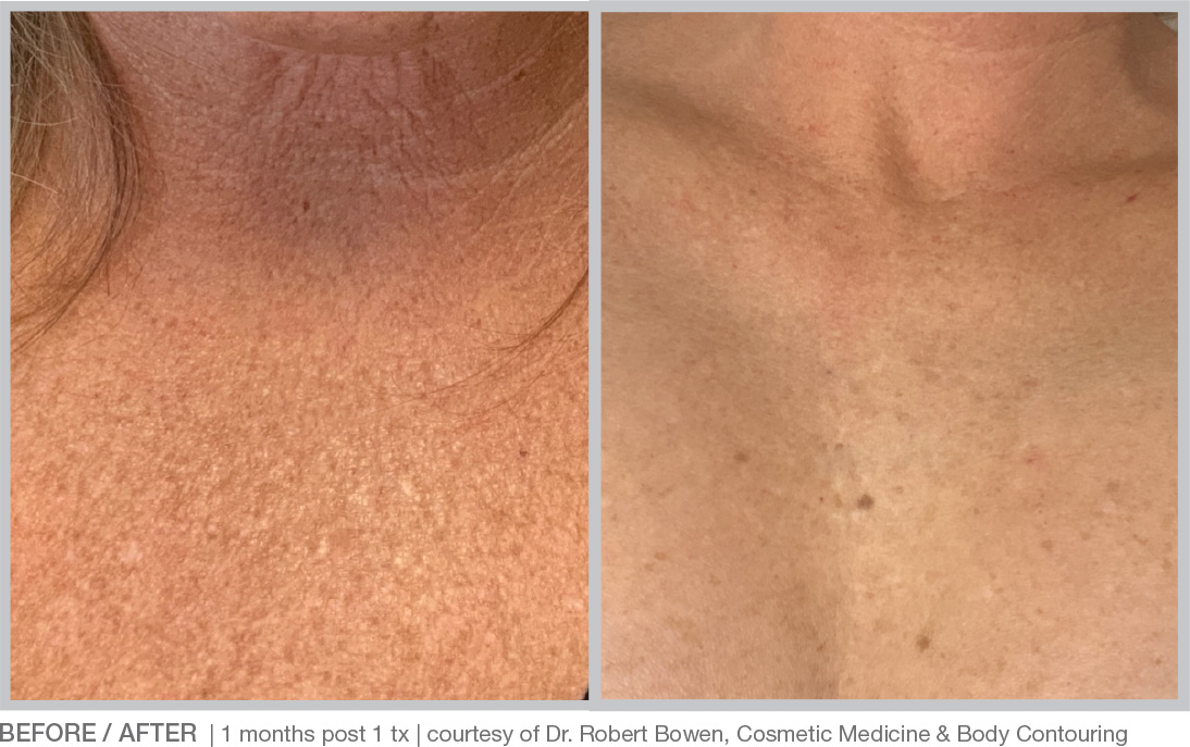 BBL Hero Before & After Results
