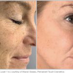 BBL Hero Before & After Results