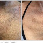 BBL Hero Before & After Results