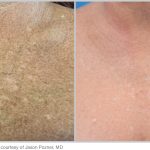 BBL Hero Before & After Results