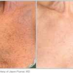 BBL Hero Before & After Results