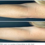 BBL Hero Before & After Results