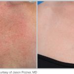 BBL Hero Before & After Results