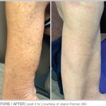 BBL Hero Before & After Results