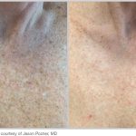 BBL Hero Before & After Results