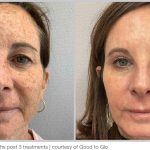 BBL Hero Before & After Results