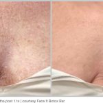BBL Hero Before & After Results