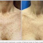 BBL Hero Before & After Results