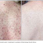 BBL Hero Before & After Results
