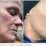 BBL Hero Before & After Results