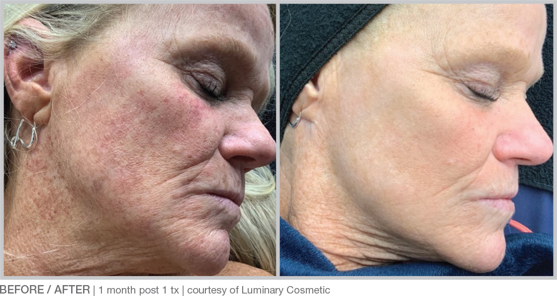 BBL Hero Before & After Results
