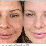 BBL Hero Before & After Results