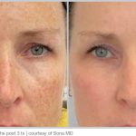BBL Hero Before & After Results