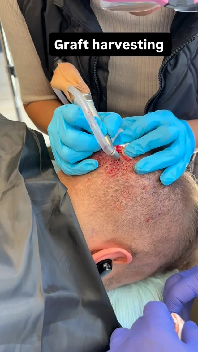Every successful hair restoration starts with careful graft harvesting. Precision at every step makes all the difference. ✨

Curious if you’re a candidate for hair restoration? Schedule a consultation today.

#hairtransplantchicago #hairtransplant #chicago #chicagomedspa #restorativemedspa